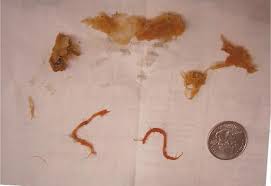 parasites in humans stomach